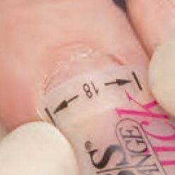Ortesis de fibra con memoria molecular para aplicar en uñas encarnadas. el uña y el clip se pueden pintar con colores.