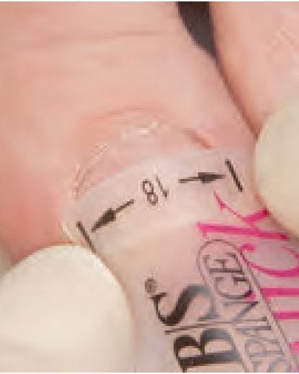 Ortesis de fibra con memoria molecular para aplicar en uñas encarnadas. el uña y el clip se pueden pintar con colores.